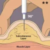Subcut Injection Kit (Peptides) - Image 3